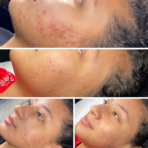 AHA vs BHA: How to Choose According to Your Skin Needs