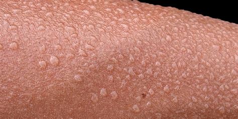 Traitement hyperhidrose | Clinique Médico-Esthétique Genève