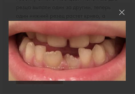 У ребенка криво растет коренной зуб,что с этим делать теперь ?Фото ...