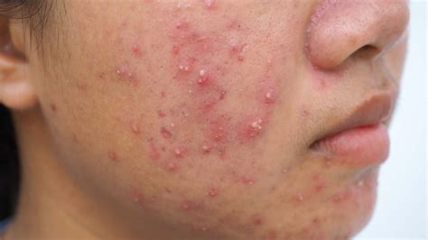 makeup  cystic acne mugeek vidalondon