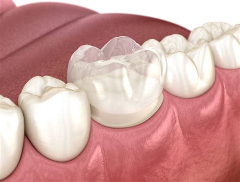 How Much Does A Dental Crown Cost In Perth? - National Dental Foundation