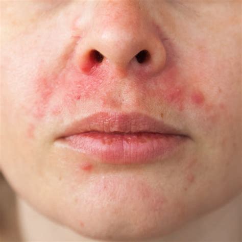 The Ultimate Guide to Treating Facial Eczema – Eczema Honey Co