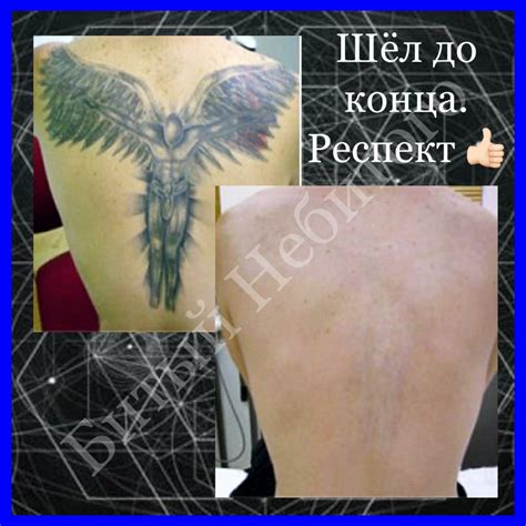 Удаление тату на спине