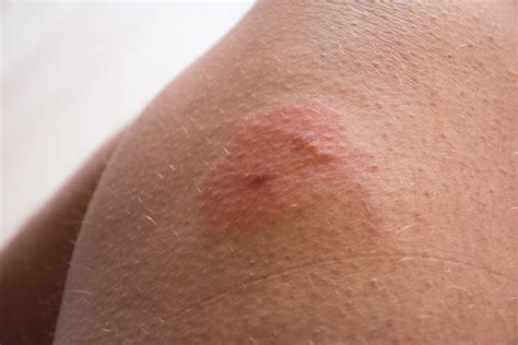Different bug bites that itch - ratediki