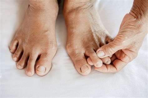 Psoriatic Arthritis (PsA) Toes: Symptoms, Causes, Treatment