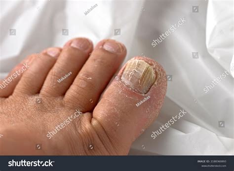 Topical Antifungal Treatment Seen Big Toe Stock Photo 2188360893 ...