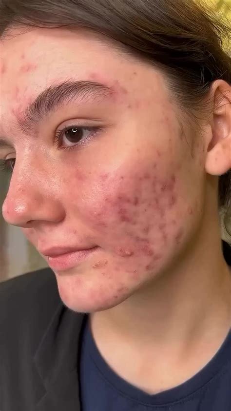 🌿Лечение рубцов постакне 🧬Постакне - это состояние, при котором на коже ...
