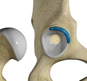 hip labral reconstruction lewisburg wv hip labral tear ronceverte wv