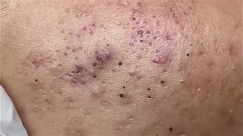 Unbelievable Blackhead Removal 2024: The Ultimate Guide to Poreless Skin - 20o2eqx
