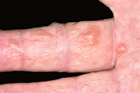 Dyshidrotic Eczema: Pictures, Symptoms, Causes & Treatment