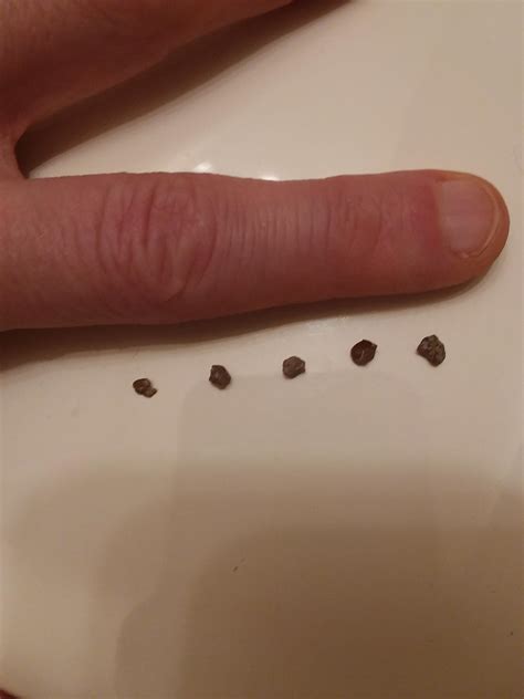 4mm Kidney Stone started its journey. 2 other non obstructing found