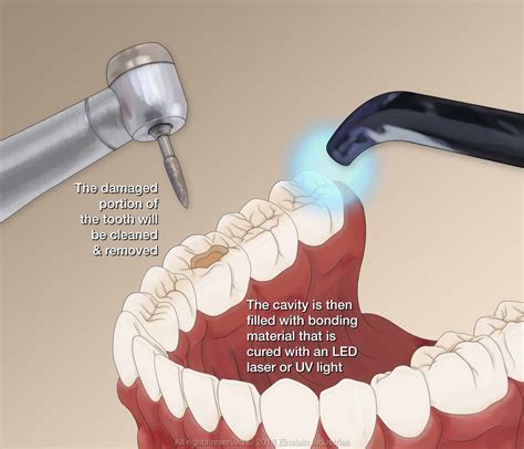 Dental Cavity Procedure at Wayne Tisdale blog