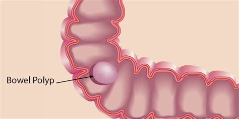 Should You Be Concerned About Bowel Polyps? | Liver Doctor