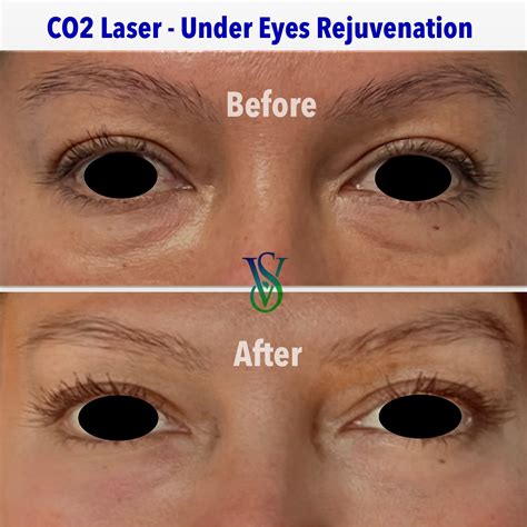 Under Eyes Bags & Dark Circles CO2 laser correction in Glendale CA
