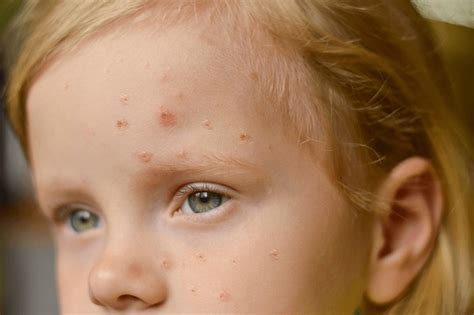 2,946 Baby Pox Royalty-Free Images, Stock Photos & Pictures | Shutterstock