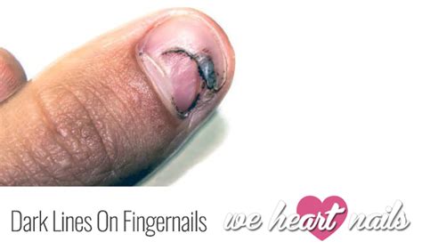 Dark Lines on Fingernails | Causes, Prevention & Treatment