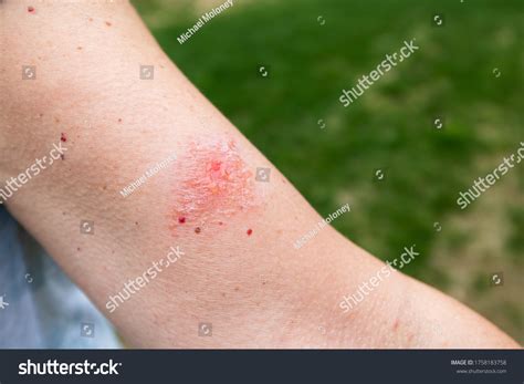 523 Poison Oak Rash Images, Stock Photos & Vectors | Shutterstock