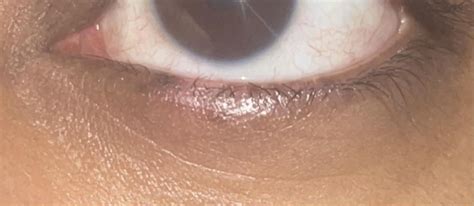 Finally filiform wart removed , no medicines ointments worked , was ...