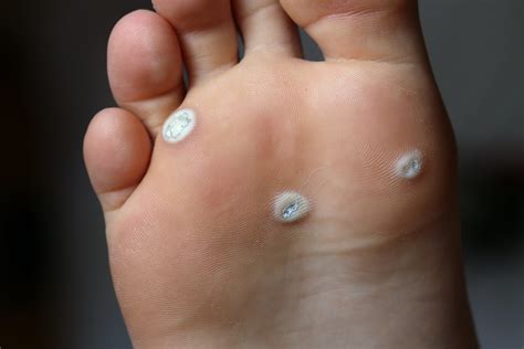 warts   toes