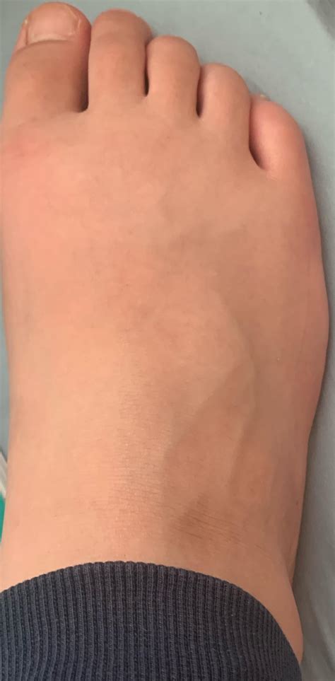 Sprained foot : r/injuries