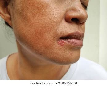 throat herpes