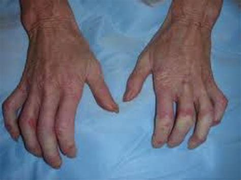 Sclerodactyly - MEDizzy