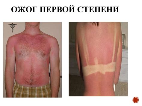 Ожоги: диагностика и приемы оказания первой доврачебной помощи ...
