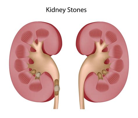 Bệnh sỏi thận: Lo lắng tìm giải pháp điều trị - TRIỆU CHỨNG BỆNH SỎI ...