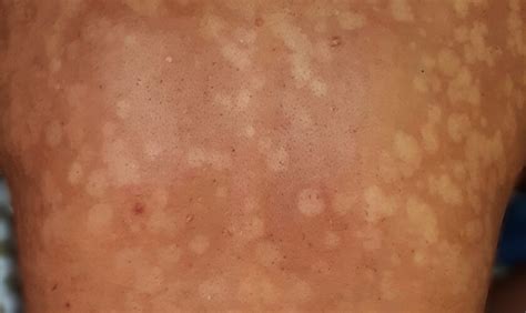 Pityriasis Versicolor - Cyprus Dermatology Clinic