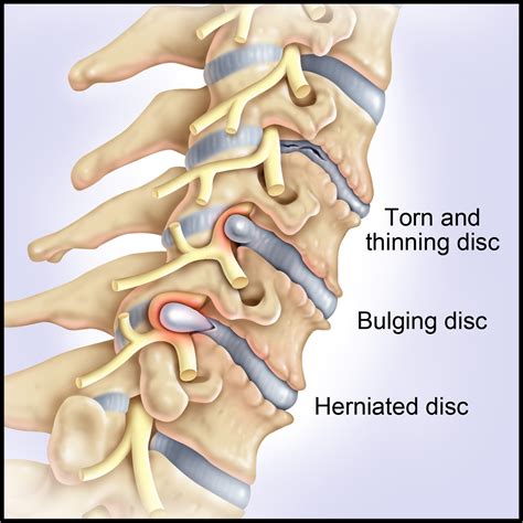 Artificial Disc (neck) – Yanni