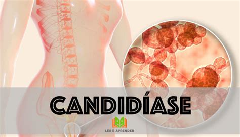 O Que Provoca Candidíase - O que é candidíase - Sintomas, tratamento, candidíase recorrente