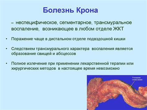 Воспалительные заболевания кишечника - презентация онлайн
