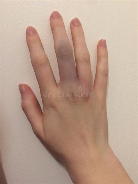 Bruised Middle Finger