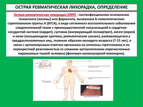 Ревматизм, ревматический кардит, ревматический полиартрит ...
