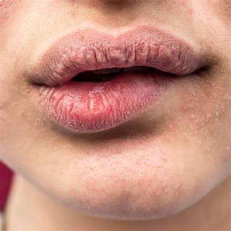 Labios Ressecado E Ardendo - Lábios ressecados: quais são as causas e como resolver?