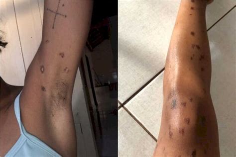 Queimadura Depilação A Laser - Mulher tem queimaduras de 2º grau após depilação a laser em Dourados ...
