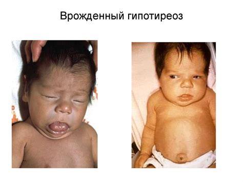 Врожденный и приобретенный гипотиреоз - online presentation
