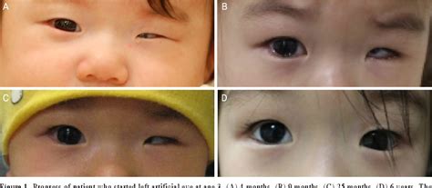 figure   clinical results  prosthetic eye wear  patients