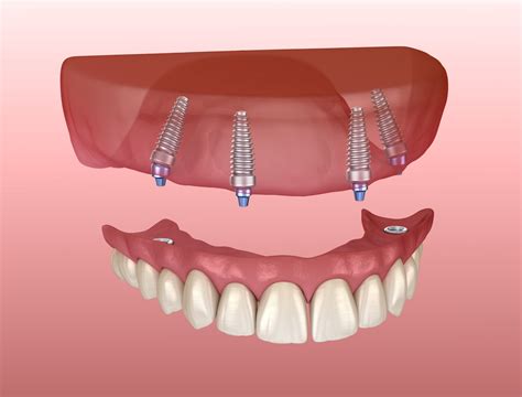 implant retained denture 2 - Costello Dental Blog