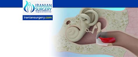 Tympanoplasty surgery | Tympanoplasty surgery time | Iranian Surgery