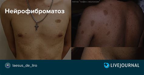 Нейрофиброматоз первого типа у ребенка: кожные и неврологические проявления