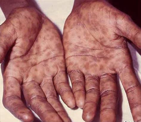 Syphilis-hands – MOBIEG