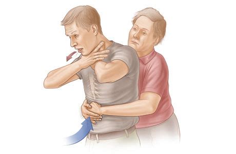 heimlich maneuver commonspirit health