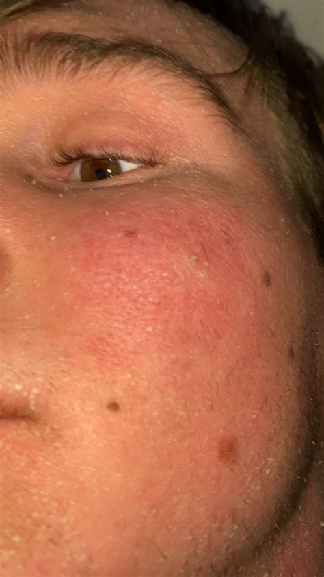 The blackheads on youtube trend has a surprising medical benefit 28