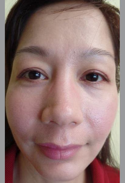 Before & After | Anti-Aging | Dr. Nguyen Health Center