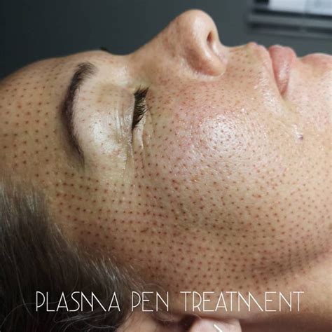 fibroblast recovery process   expect day  day