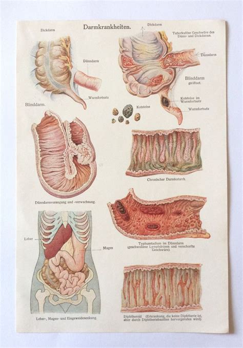 Antique Print 1920s German Medical Anatomy Organs INTESTINAL DISEASES ...