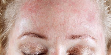 Xerosis of skin causes, symptoms, diagnosis & xerosis treatment
