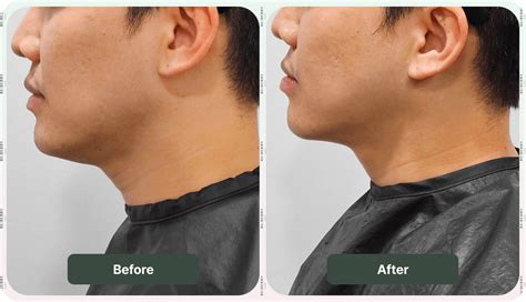 revinas treatment images reberry clinic