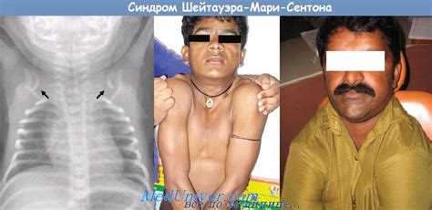Синдром Шейтауэра-Мари-Сентона (Scheuthauer-Marie-Sainton) - синонимы ...